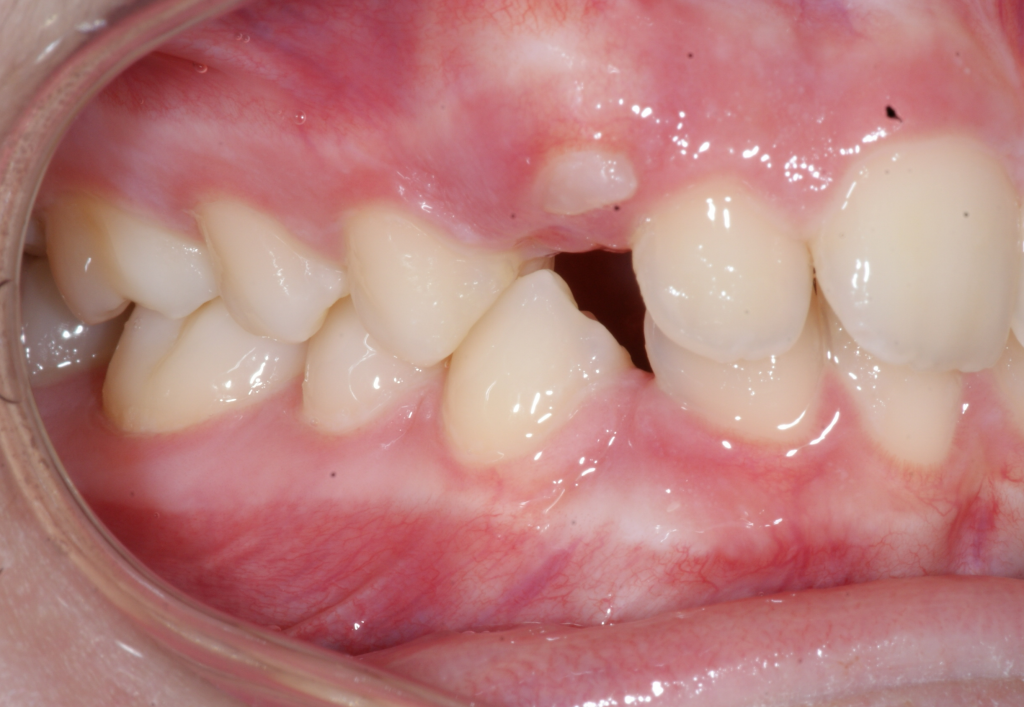 Canines incluses - Étude de cas #2 - Orthodontie Sherbrooke