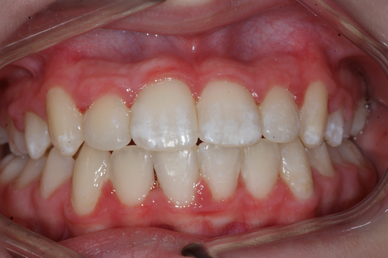 Chevauchement des dents Étude de cas 3 Orthodontie Sherbrooke