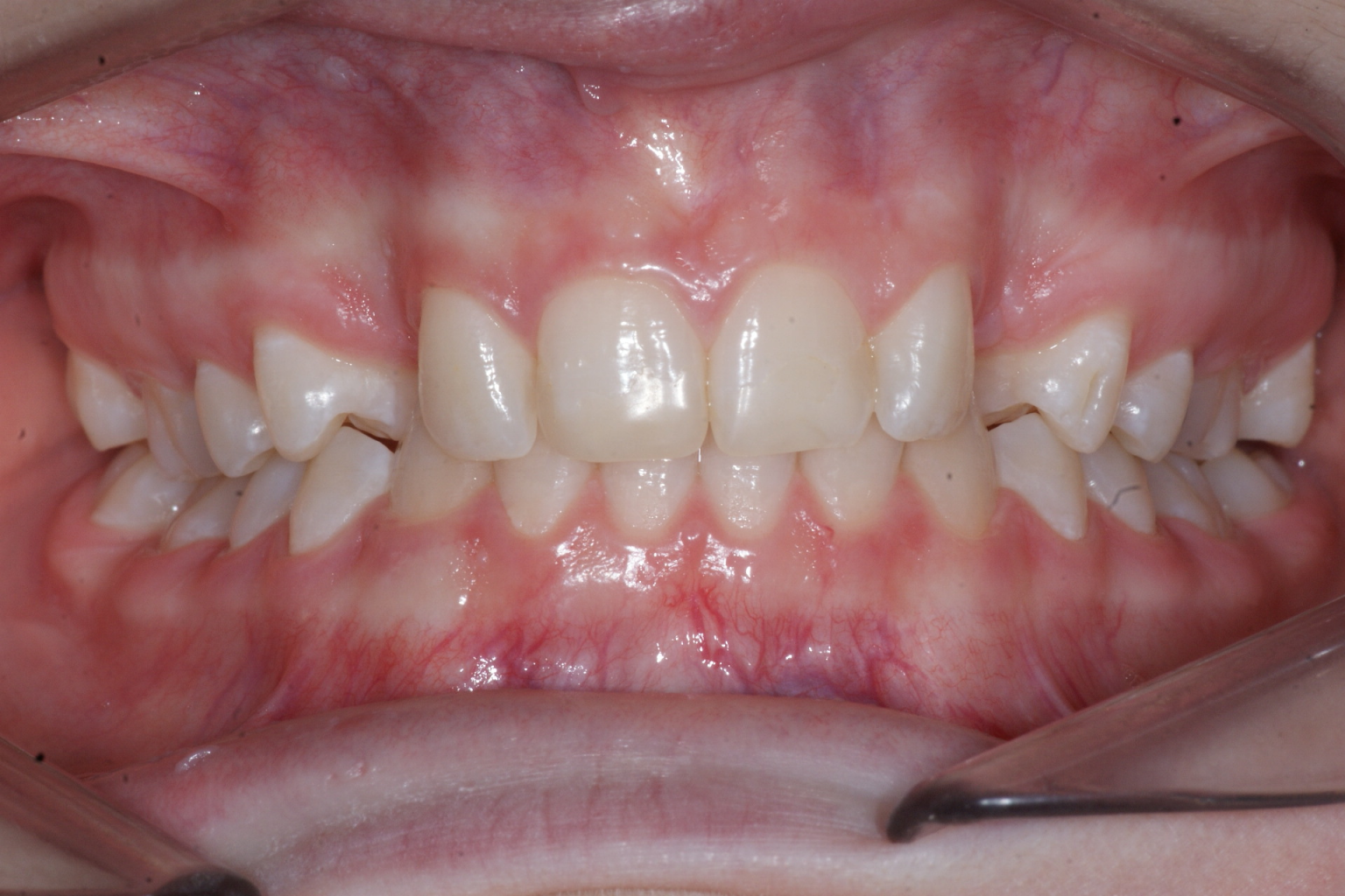 Canine incluse - étude de cas #4 - Orthodontie Sherbrooke