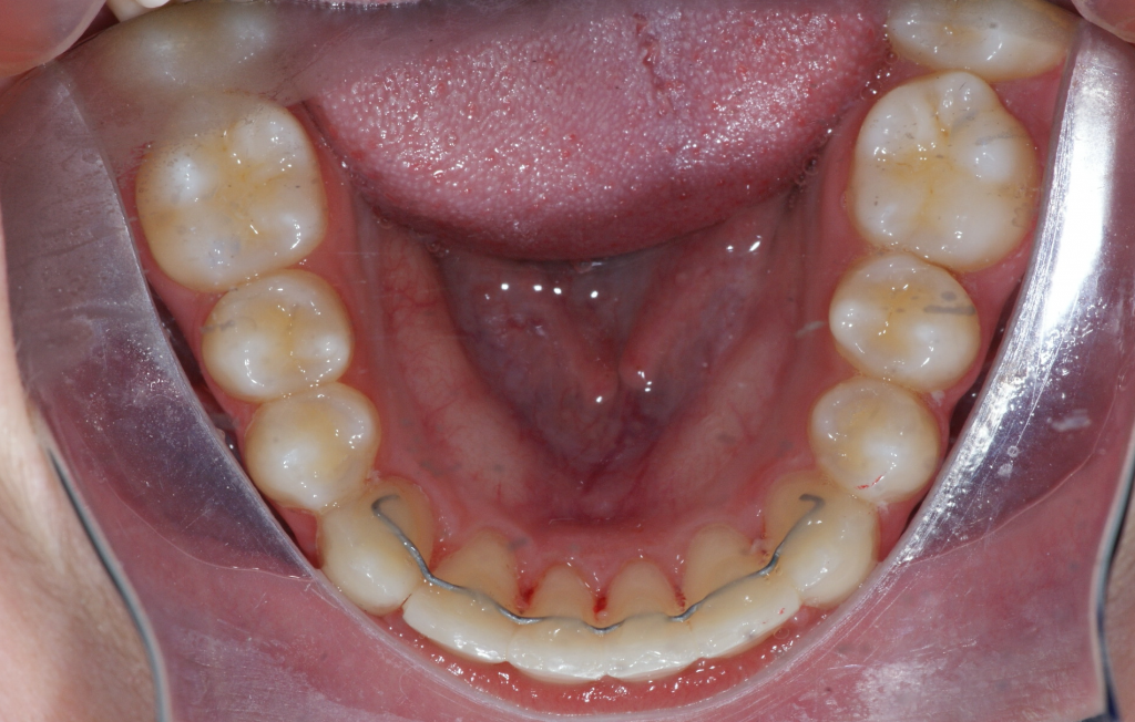 Canines incluses - Étude de cas #2 - Orthodontie Sherbrooke
