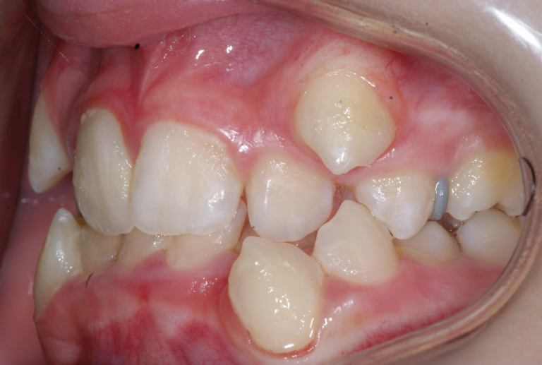 Chevauchement des dents Étude de cas 3 Orthodontie Sherbrooke