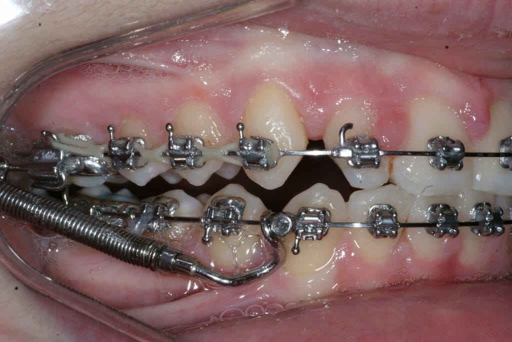 Appareil orthodontique Forsus 3M Unitek Orthodontie Sherbrooke
