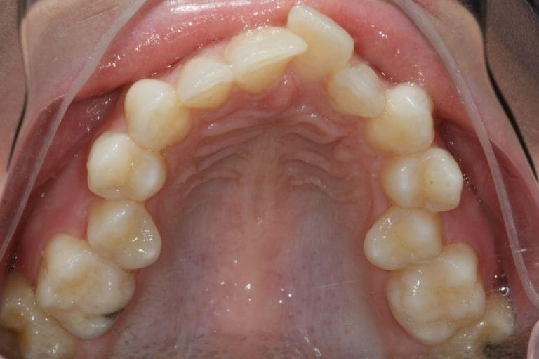 Chevauchement des dents Étude de cas 2 Orthodontie Sherbrooke