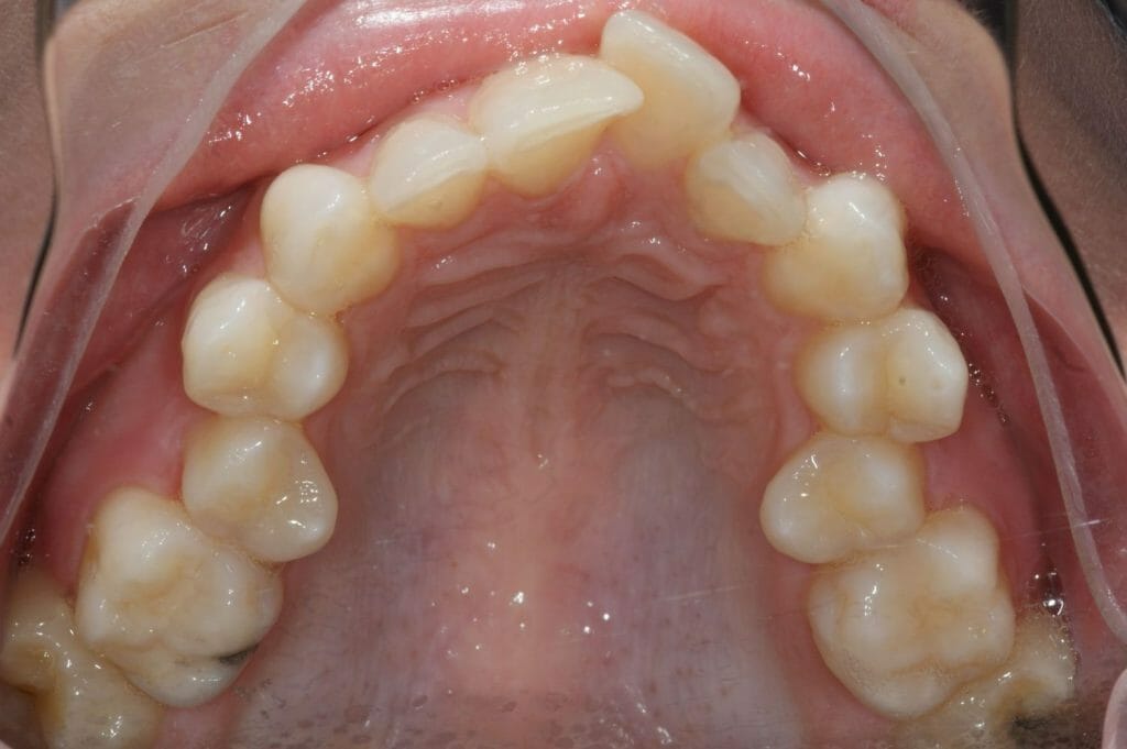 Invisalign ou Lingual, quel traitement choisir