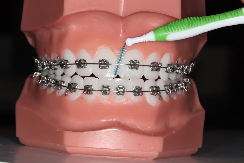 Pour nettoyer sous le fil orthodontique.  Elle vous est fournie dans la trousse de départ et il est suggéré de l'utiliser tous les jours.