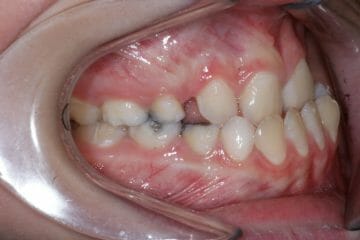 Appareil orthodontique Freddy - Avant le traitement