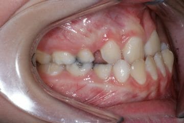 Appareil orthodontique Freddy - Avant le traitement