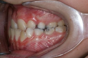 Appareil orthodontique Freddy - Avant le traitement