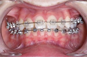 Boitiers transparents appareil orthodontique en bouche