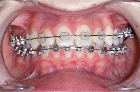 Boitiers transparents appareil orthodontique en bouche