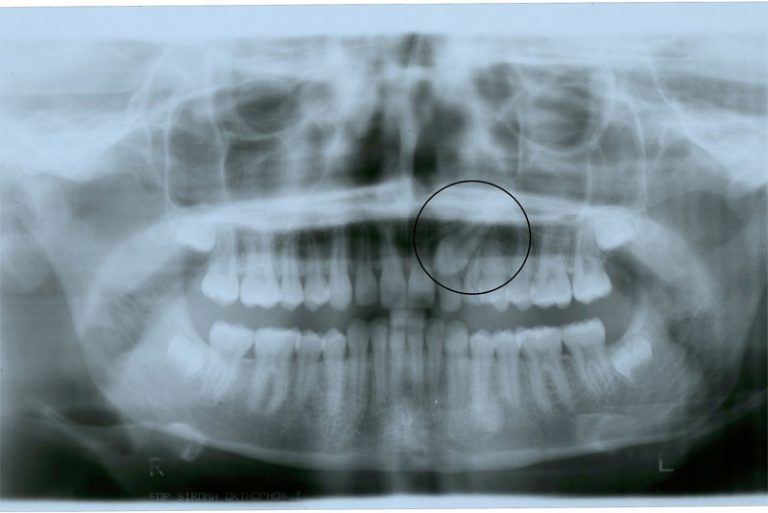 Canines incluses - Orthodontie Sherbrooke