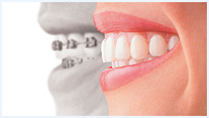 Traitement Invisalign appareil orthodontique